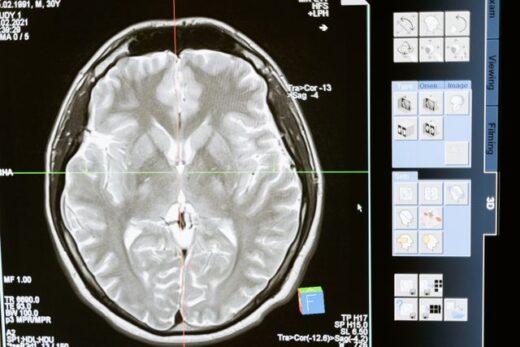 Glymphatic System and Brain Detoxification